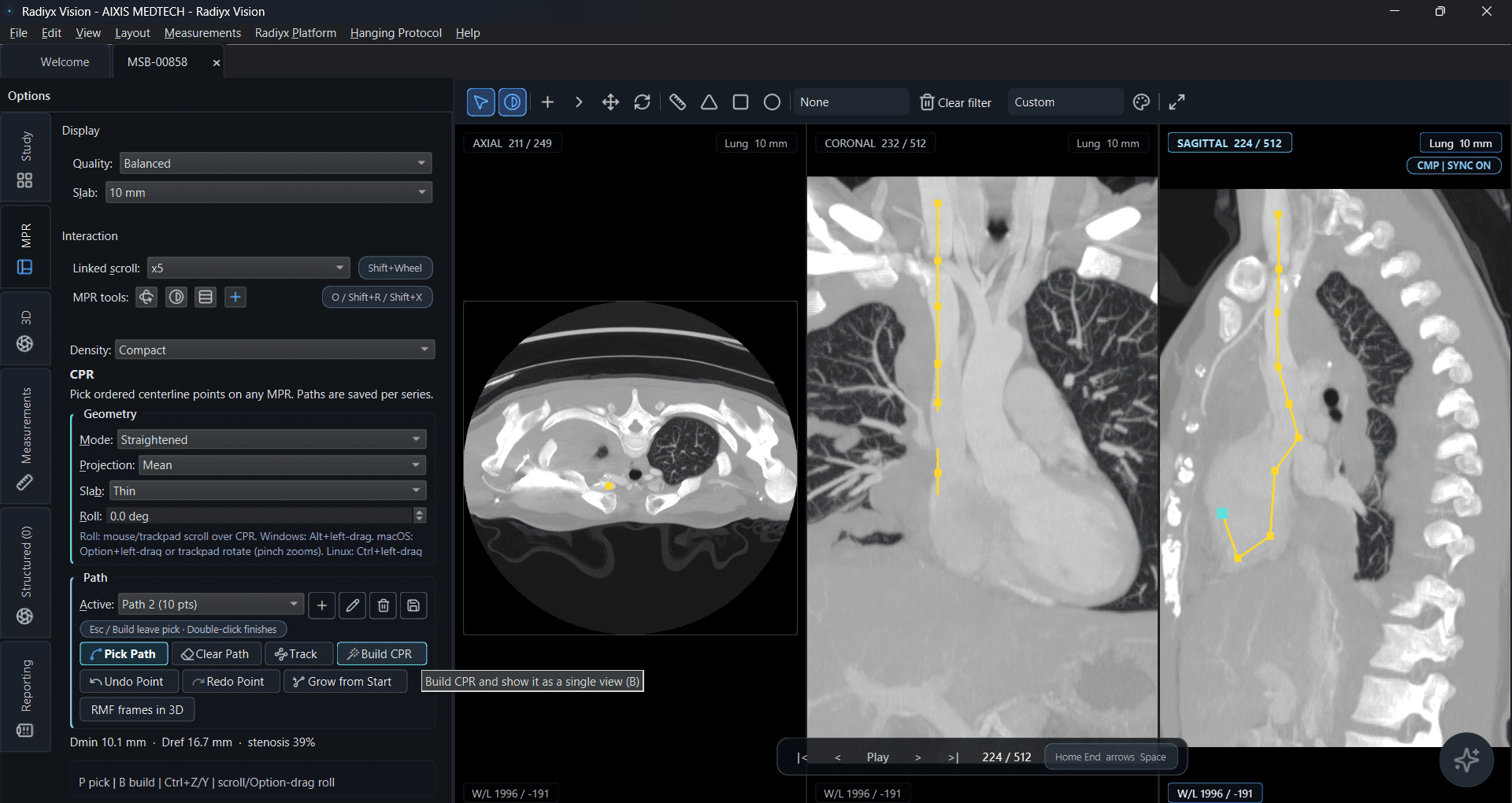 Radiyx Vision CPR workflow — centerline path creation and curved planar controls