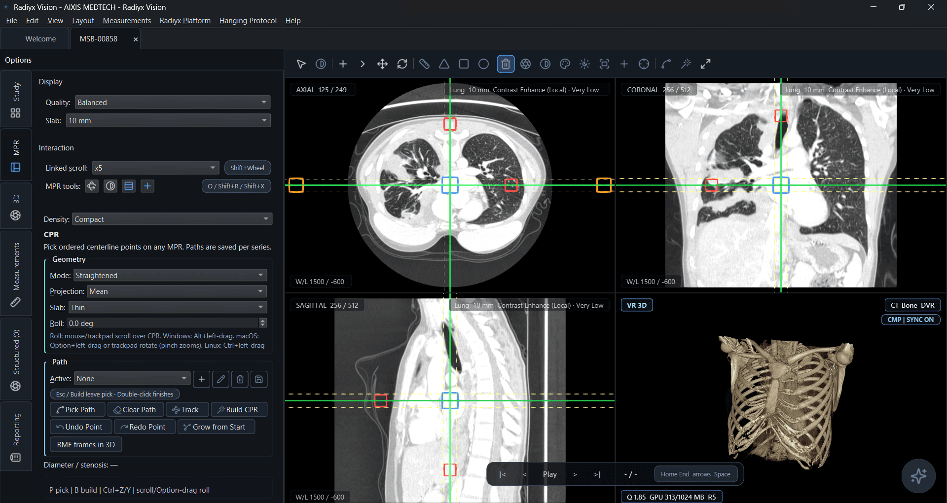 Radiyx Vision synchronized MPR planes with 3D volume rendering in one workspace